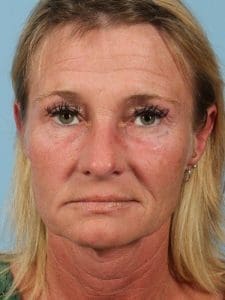 Dermal Fillers - Case 14779 - Before