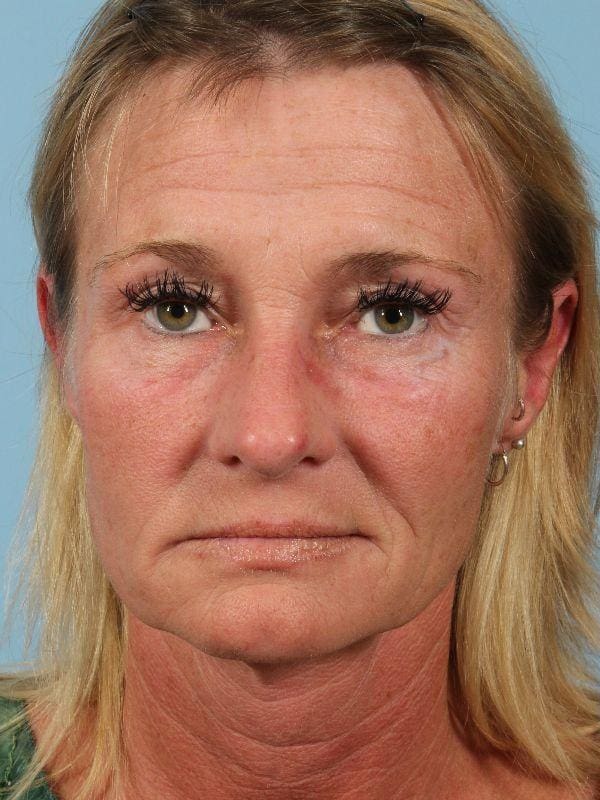 Dermal Fillers Patient Photo - Case 14779 - before view-