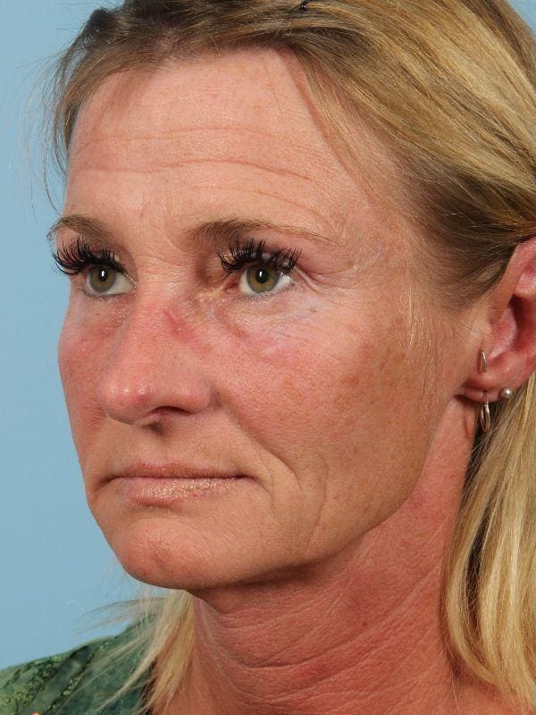 Dermal Fillers Patient Photo - Case 14779 - before view-2