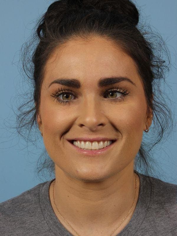 Dermal Fillers Patient Photo - Case 14788 - before view-1