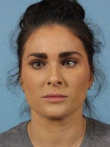 Dermal Fillers - Case 14788 - Before