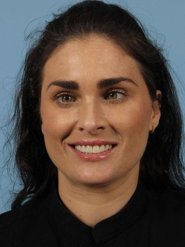 Dermal Fillers Patient Photo - Case 14788 - after view-1