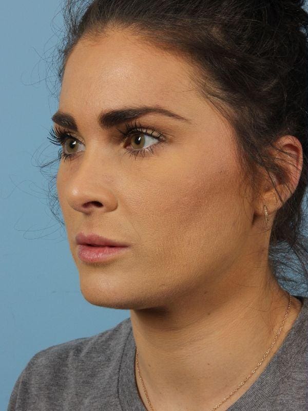 Dermal Fillers Patient Photo - Case 14788 - before view-5