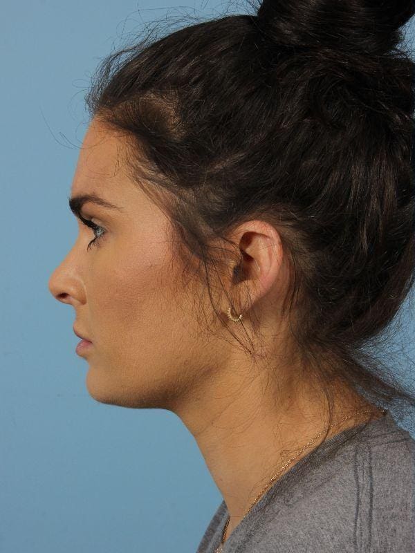 Dermal Fillers Patient Photo - Case 14788 - before view-3