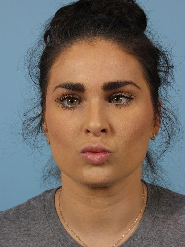 Dermal Fillers Patient Photo - Case 14788 - before view-2