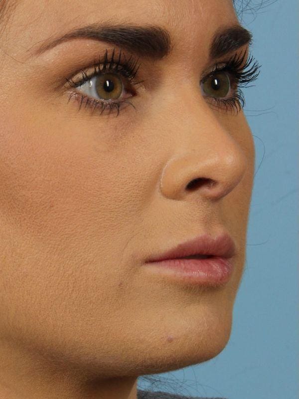 Dermal Fillers Patient Photo - Case 14788 - before view-6