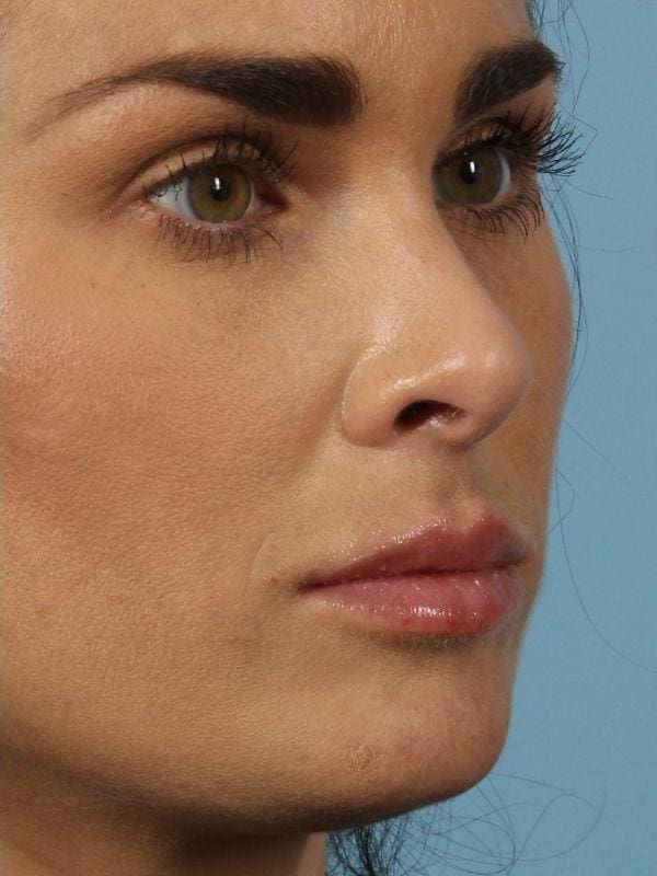 Dermal Fillers Patient Photo - Case 14788 - after view-6
