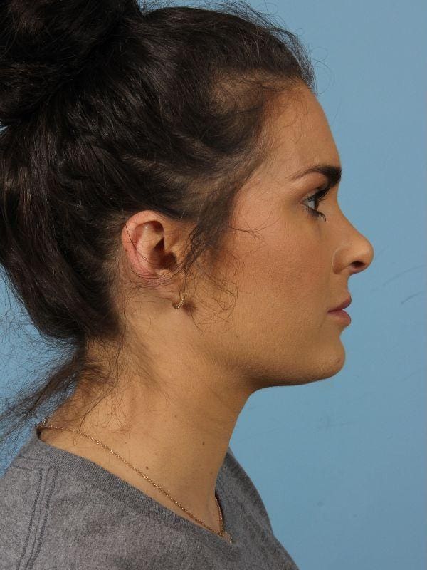 Dermal Fillers Patient Photo - Case 14788 - before view-4