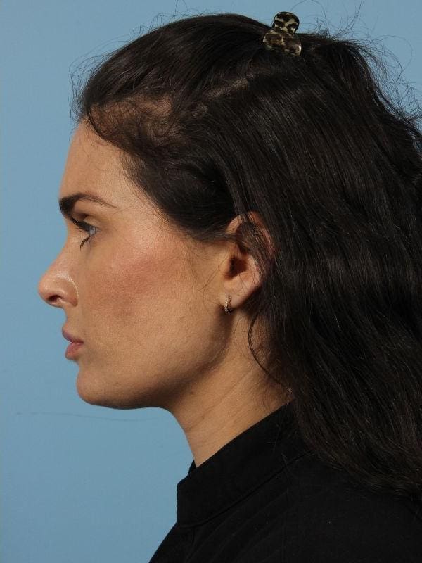 Dermal Fillers Patient Photo - Case 14788 - after view-3