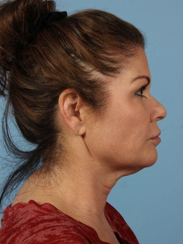 Injectable Fillers Patient Photo - Case 14804 - before view-3