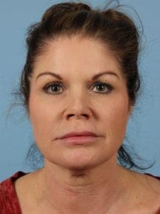 Dermal Fillers - Case 14804 - Before