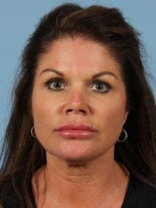 Dermal Fillers - Case 14804 - After