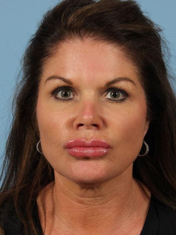 Injectable Fillers Patient Photo - Case 14804 - after view-1