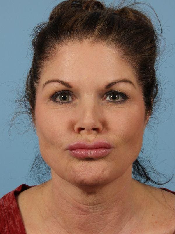 Injectable Fillers Patient Photo - Case 14804 - before view-1