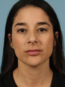 Dermal Fillers - Case 14818 - After