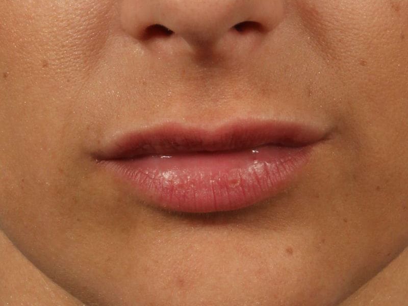 Injectable Fillers Patient Photo - Case 14818 - after view-5