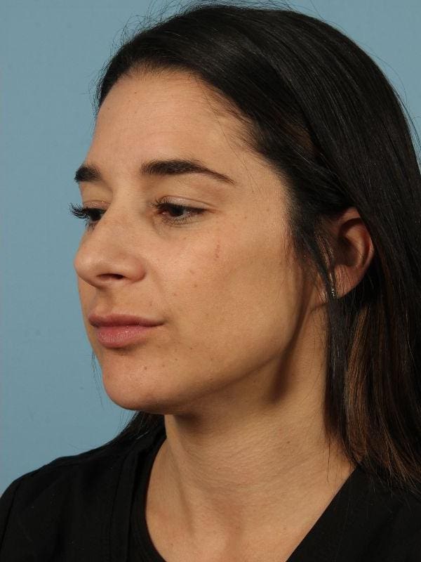 Injectable Fillers Patient Photo - Case 14818 - after view-3