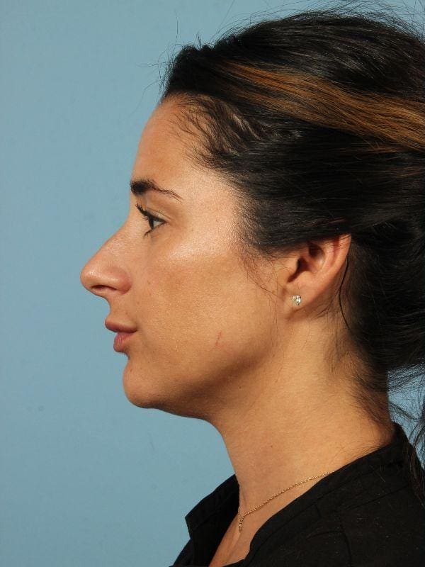 Injectable Fillers Patient Photo - Case 14818 - before view-1