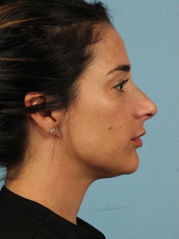 Injectable Fillers Patient Photo - Case 14818 - before view-2