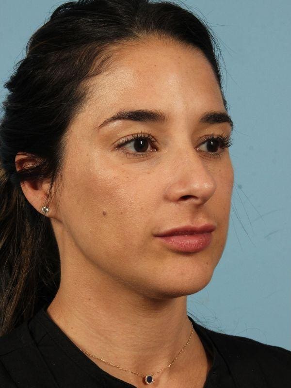 Injectable Fillers Patient Photo - Case 14818 - before view-4