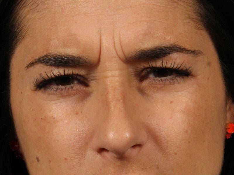 Dermal Fillers Patient Photo - Case 14833 - before view-1
