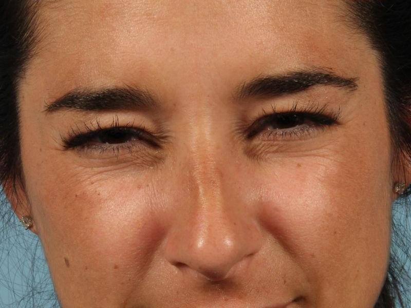 Dermal Fillers Patient Photo - Case 14833 - after view-1