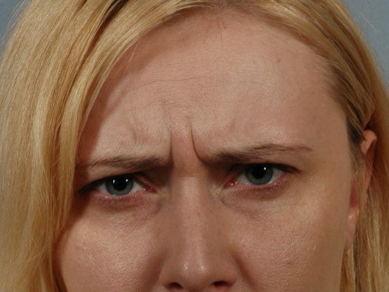 Injectable Fillers Patient Photo - Case 14839 - before view-1