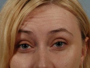 Dermal Fillers - Case 14839 - Before