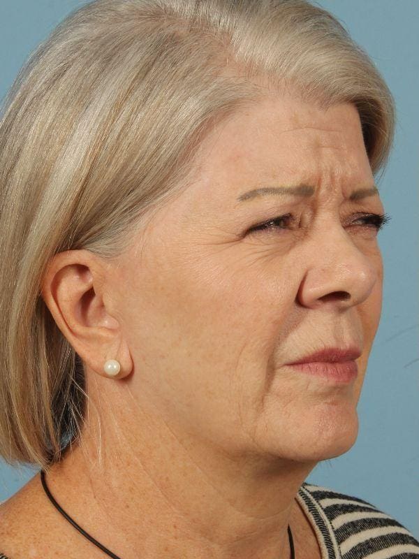 Dermal Fillers Patient Photo - Case 14846 - before view-1