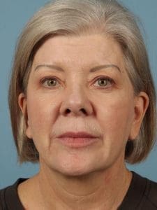 Dermal Fillers - Case 14846 - After