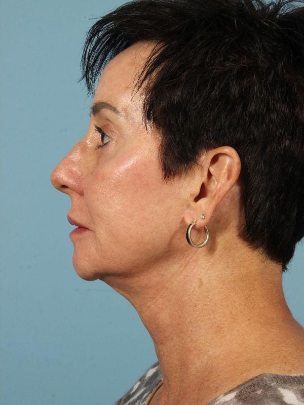 Injectable Fillers Patient Photo - Case 14852 - after view-1