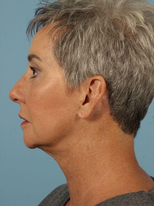 Injectable Fillers Patient Photo - Case 14852 - before view-1