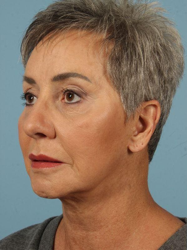 Injectable Fillers Patient Photo - Case 14852 - before view-3