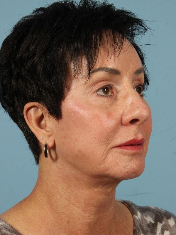 Injectable Fillers Patient Photo - Case 14852 - after view-4