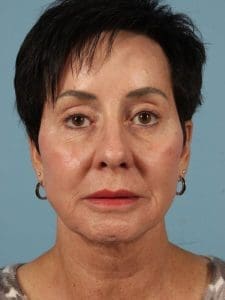 Dermal Fillers - Case 14852 - After