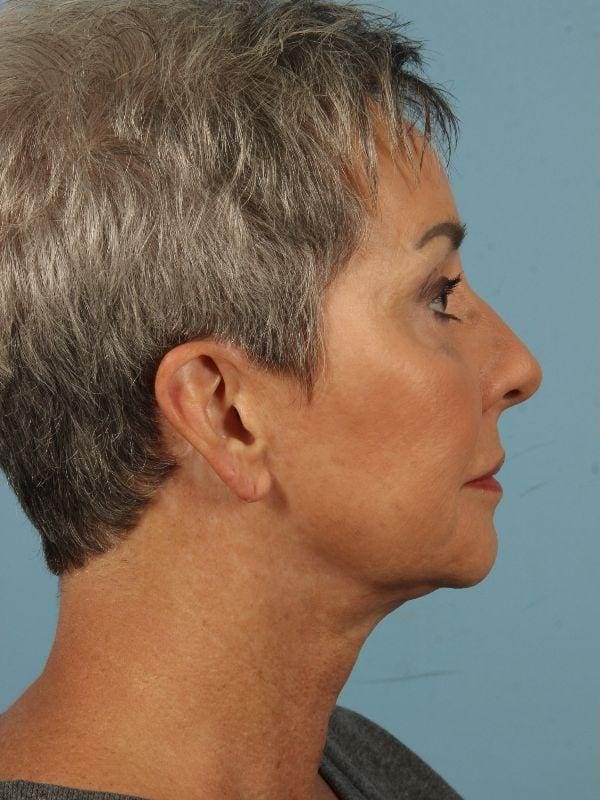 Injectable Fillers Patient Photo - Case 14852 - before view-2