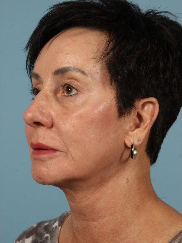 Injectable Fillers Patient Photo - Case 14852 - after view-3