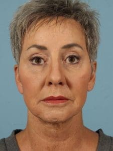 Dermal Fillers - Case 14852 - Before