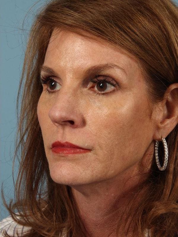 Dermal Fillers Patient Photo - Case 14864 - after view-3