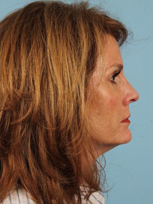 Dermal Fillers Patient Photo - Case 14864 - after view-2
