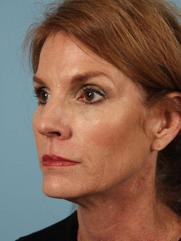 Dermal Fillers Patient Photo - Case 14864 - before view-3