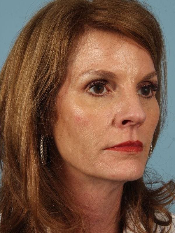 Dermal Fillers Patient Photo - Case 14864 - after view-4