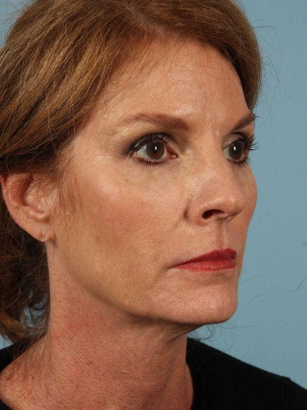 Dermal Fillers Patient Photo - Case 14864 - before view-4