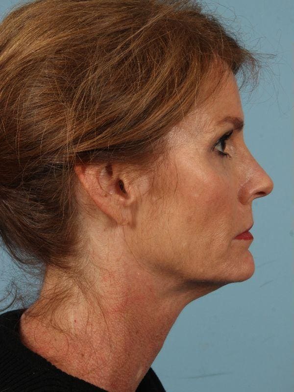 Dermal Fillers Patient Photo - Case 14864 - before view-2