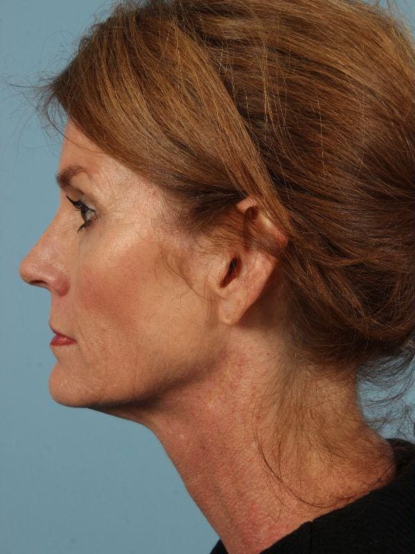 Dermal Fillers Patient Photo - Case 14864 - before view-1