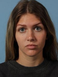 Dermal Fillers - Case 14876 - Before