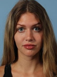 Dermal Fillers - Case 14876 - After