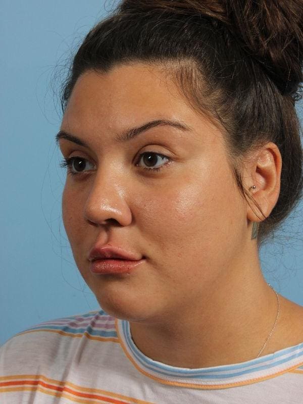 Dermal Fillers Patient Photo - Case 14896 - after view-3