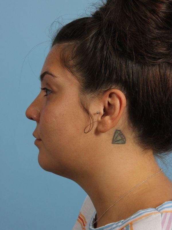 Dermal Fillers Patient Photo - Case 14896 - before view-1