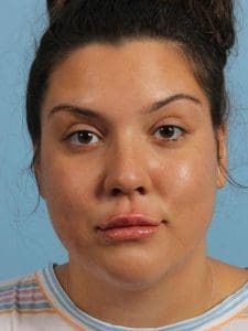 Dermal Fillers - Case 14896 - After